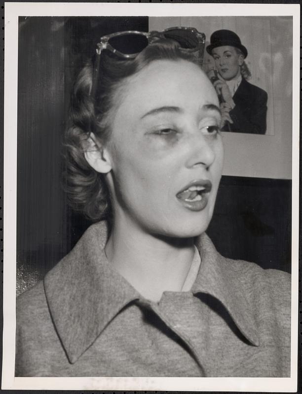 Stork Club secretary shows evidence of attack