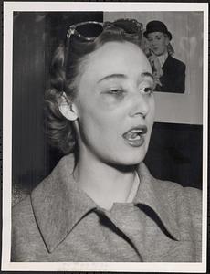 Stork Club secretary shows evidence of attack