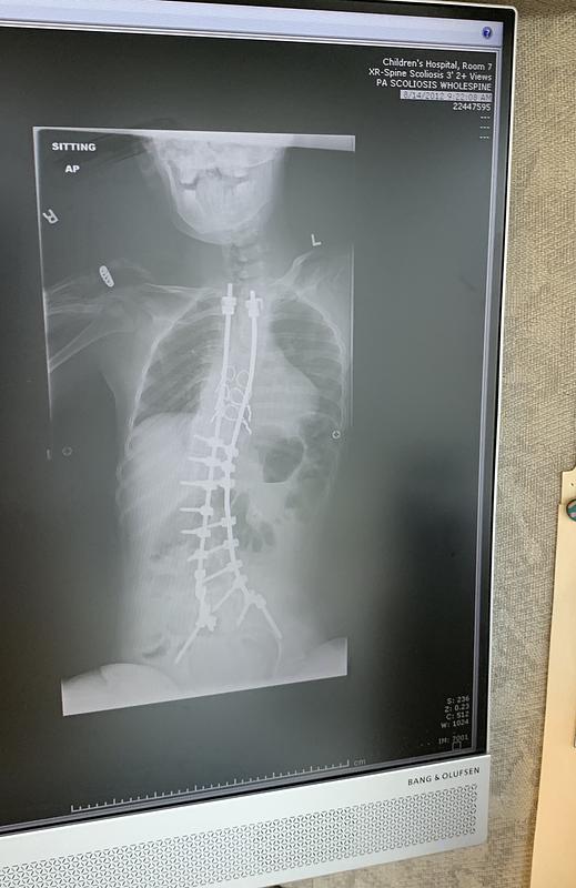 Post spinal fusion x-ray