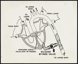 The heart is a dual two-stage pump, with inlet and outlet valves working in tandem for each “beat”. Blood enters through separate veins from upper and lower body extremities into the right auricle, from there to the right ventricle and out to the lungs for carbon dioxide removal. It returns, again through the separate veins, from the left and right lungs into the left auricle, and thence to the left ventricle. From here the flow is normally through the aortic valve, but when this valve narrows and tightens blood backwashes into the ventricle, forcing the heart to work harder to remove it. Sometimes the strain is just too much. The Silastic valve relieves this condition by by-passing the damaged valve entirely.