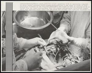 The actual operation 12/2 at University Hospital in which Donald Kaminski, 38, of Alpena, Mich., received a new heart is shown in this photograph released by the hospital. Kaminski's own heart is held by surgeon as it is lifted from the chest cavity. Tubes lead to a large cabinet-size "artificial heart" which kept Kaminski alive until the new heart was shocked into life.