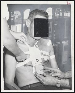 Portable infusion pump being attached to patient at Lahey Clinic to treat metastatic liver cancer. The pump, in a harnessed leather case carried about the neck, contains a five-day supply of drug in a disposable plastic bag. A simple clock mechanism (see detail below) pumps the fluid into tubing attached to the catheter running down patient's arm.
