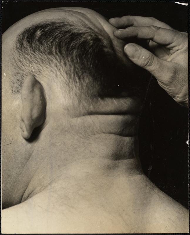 Inspecting ridges on scalp