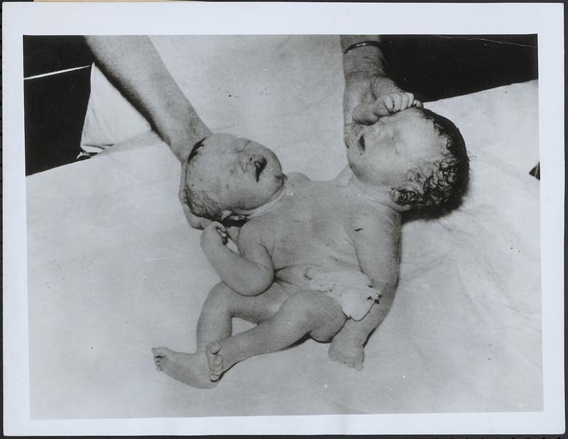 Born with 2 heads, 4 arms at Indianapolis hospital