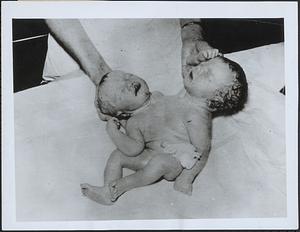 Born with 2 heads, 4 arms at Indianapolis hospital