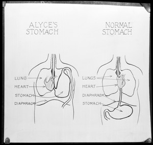 Diagram showing Alyce McHenry's stomach