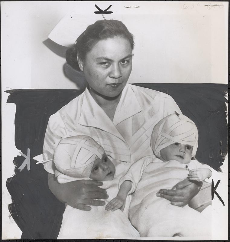 Siamese twins separated