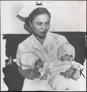 Siamese twins separated