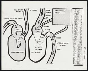 How Artificial Heart Was Used in Surgery--This schematic diagram shows how blood flowing into a human heart was detoured into a mechanical heart and then pumped back into the body, by-passing the left side of the heart. A 41-year-old man recently underwent heart surgery using the machinery for a 50-minute operation. Medical researchers said they believed it was the first known instance of a patient's survival through the use of an artificial heart mechanism. Surgery was performed on a valve in the left ventricle.