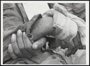 Injured hand