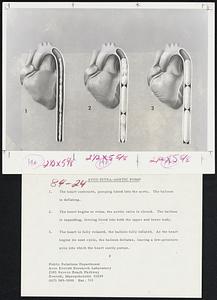 Avco Intra-Aortic Pump. 1. The heart contracts, pumping blood into the aorta. The balloon is deflating. 2. The heart begins to relax; the aortic valve is closed. The balloon is expanding, forcing blood into both the upper and lower body. 3. The heart is fully relaxed, the balloon fully inflated. As the heart begins its next cycle, the balloon deflates, leaving a low-pressure area into which the heart easily pumps.