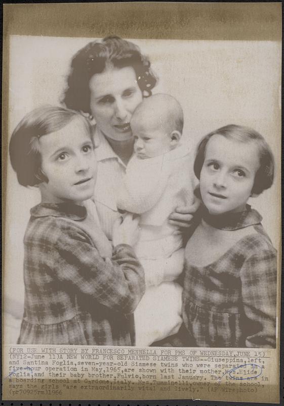 A new world for separated Siamese twins