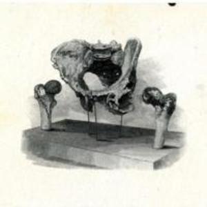 Engraving of Charles Lowell's hip bone