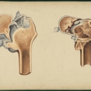 Teaching watercolor of two ununited fractures of the femur