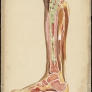 Teaching watercolor of interior of diseased tibia