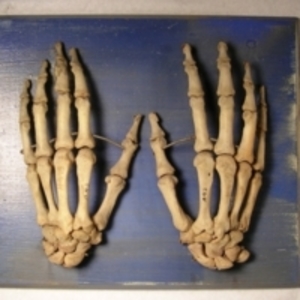 Healthy left and right hand bones of a 46-year-old man