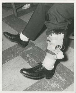 William Buderson demonstrating a leg prosthetic