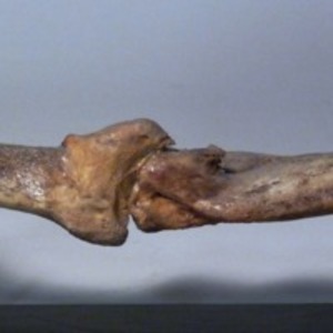 Humerus with ununited fracture