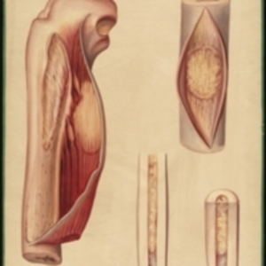 Teaching watercolor of the degeneration of the tibia and marrow caused by syphilis