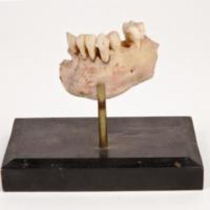 Fragment of mandible lost from gunshot wound