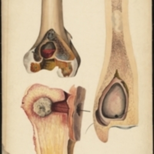 Teaching watercolor of diseased bone