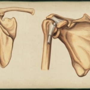 Teaching watercolor of a dislocation of the scapular extremity of the clavicle and a partial dislocation of the shoulder