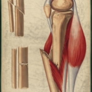 Teaching watercolor of fractures in the tibia and fibula