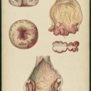 Teaching watercolor showing diseases of the rectum