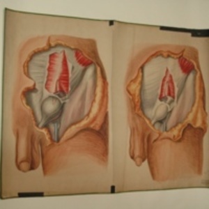 Teaching watercolor of male with inguinal hernia, after Richard Quain's The Anatomy of the Arteries of the Human Body, 1848-1854
