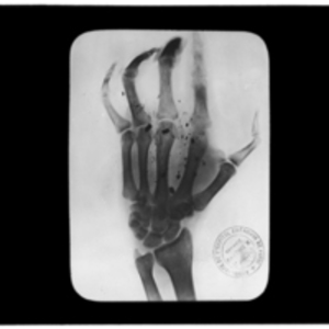 X-ray of hand with shrapnel scattered throughout
