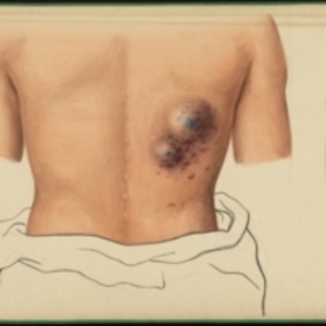 Teaching watercolor of tumors on the back of a male patient