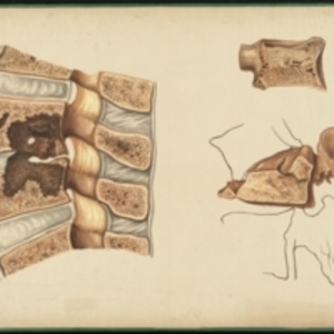 Teaching watercolor of the effects of tuberculosis on the spine