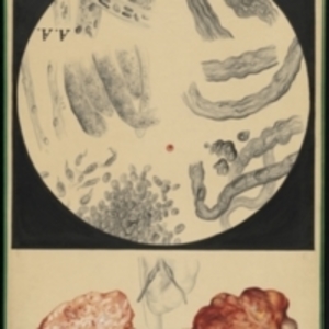 Teaching watercolor of a bone tumor and a microscopic view of the tissue