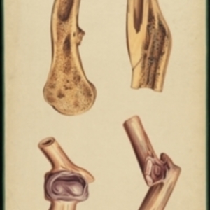 Teaching watercolor of the reparation of fractures, resulting in both united and ununited fractures