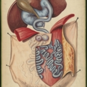 Teaching watercolor of the abnormal dilation of the subcutaneous abdominal veins