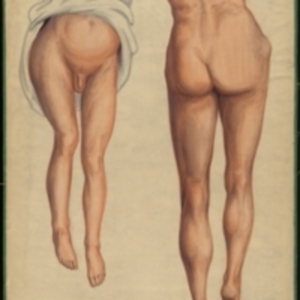 Teaching watercolor of the later stages of hip disease, showing the apparent shortening of the leg on the diseased side