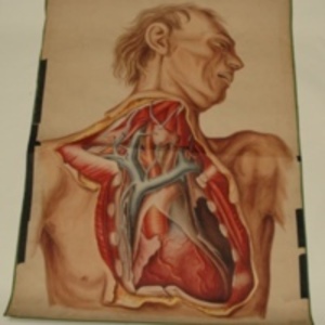 Teaching watercolor of man with surgically opened chest, 1848-1854