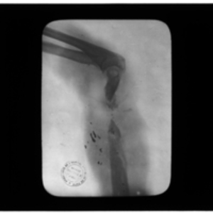 X-ray of arm with shattered humerus and scattered shrapnel