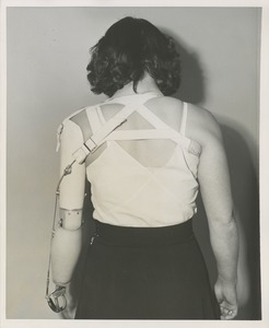 A woman shows the back of her prosthetic arm device