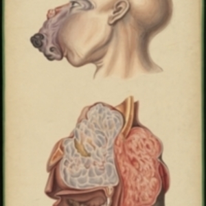 Teaching watercolor of exterior and interior views of a large bone tumor of the upper jaw which filled the cavities of the nose and orbits and extended into the cranium