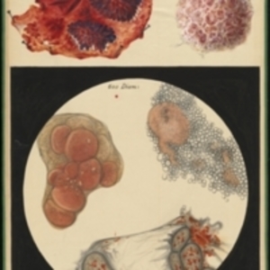 Teaching watercolor of removed tissue and a microscopic view of it