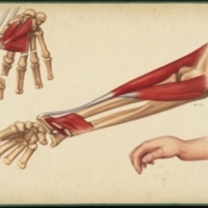Teaching watercolor of fractures in the radius and ulna near the wrist and fractures of the fingers