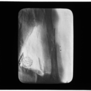 X-ray of broken humerus