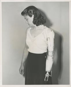 A patient models her new prosthetic arm device