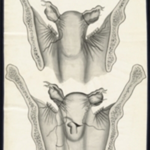 Teaching watercolor of total abdominal hysterectomy