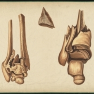 Teaching watercolor of osteonecrosis and shattered bone which caused amputation of the limb