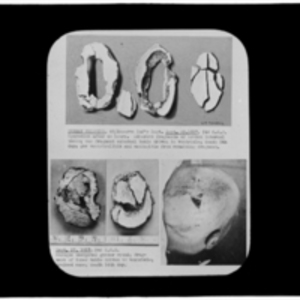 Oblique occipital gutter wound