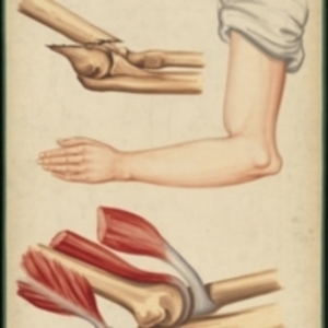 Teaching watercolor showing dislocations and a fracture at the elbow
