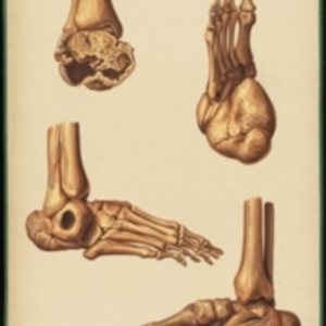 Teaching watercolor of bone deformity in the heel