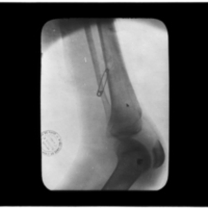 X-ray of safety pin in leg